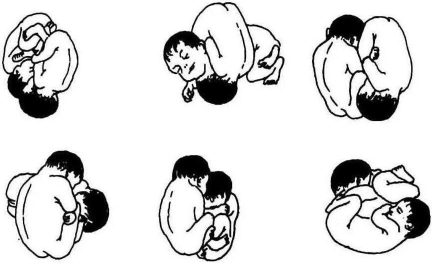 第四節(jié) 多胎妊娠